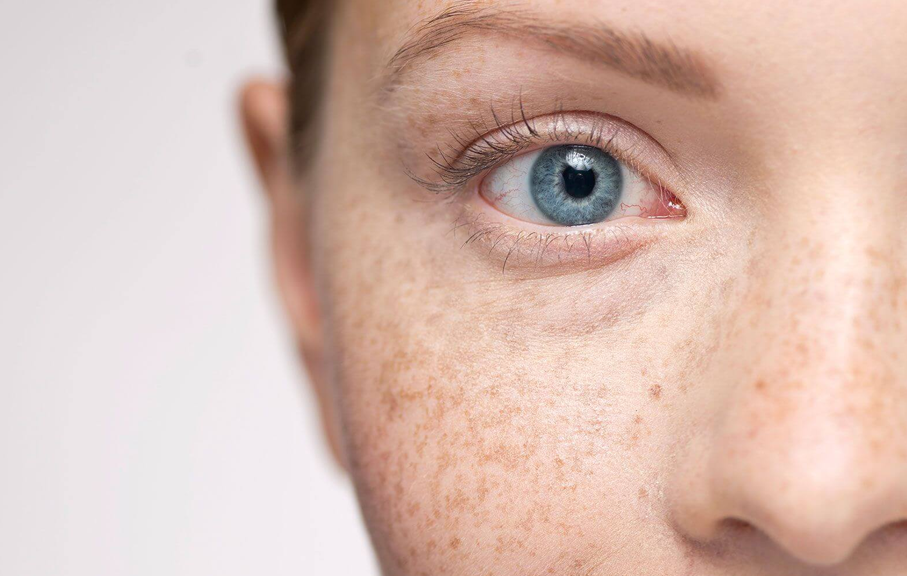 Freckles Removal