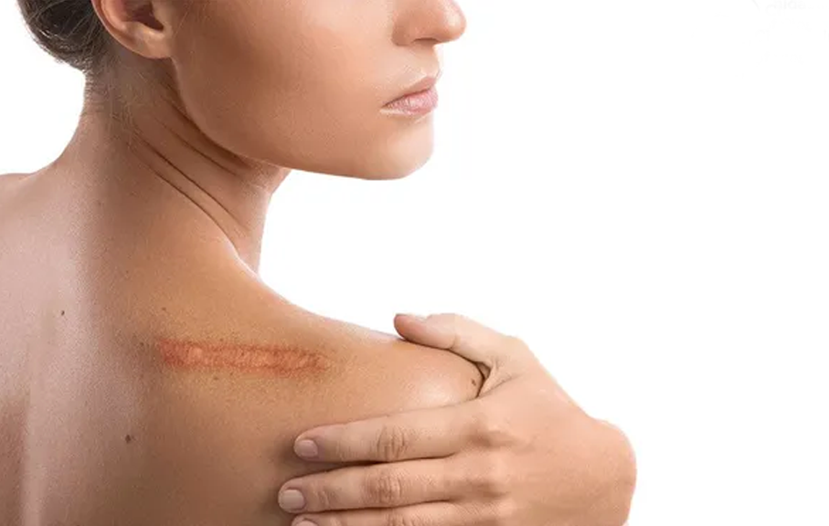 Scar Removal